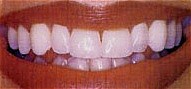 After whitening